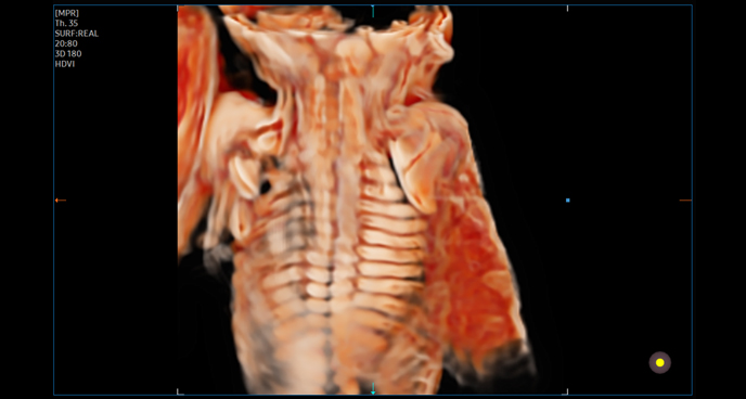 3d imaging : Fetal spine with CrystalVue™