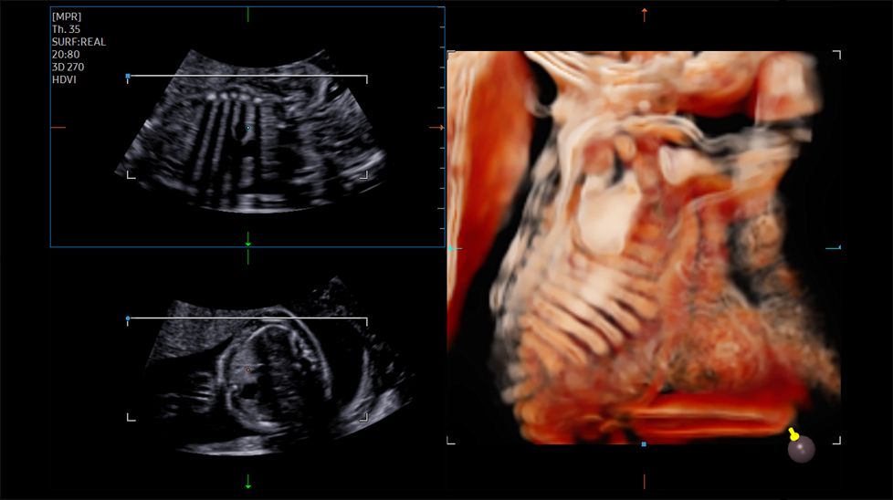 3d imaging : Fetal ribs and scapula with CrystalVue™