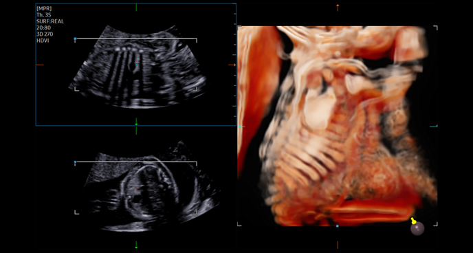 3d imaging : Fetal ribs and scapula with CrystalVue™