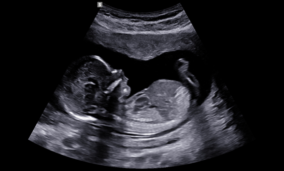 2d images : 1st trimester fetal profile view