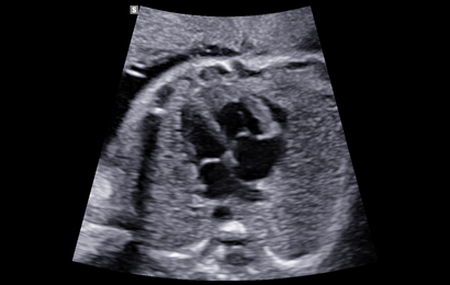 2d images : Fetal heart 4ch view