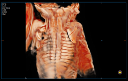 3d imaging : Fetal spine with CrystalVue™