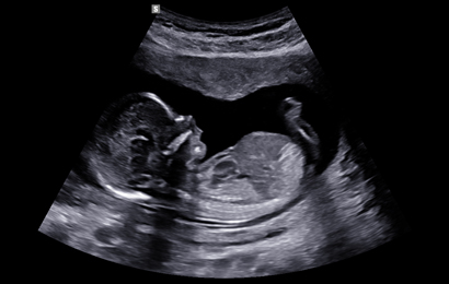 2d images : 1st trimester fetal profile view