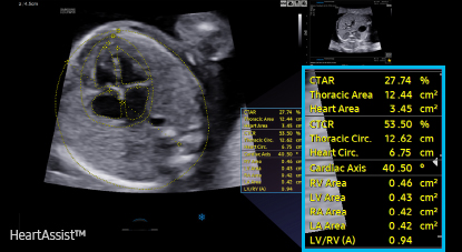 cardiac solutions : HeartAssist™