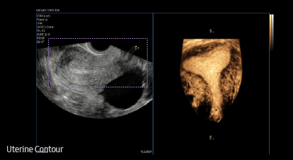 advanced gyn solutions : Uterine Contour