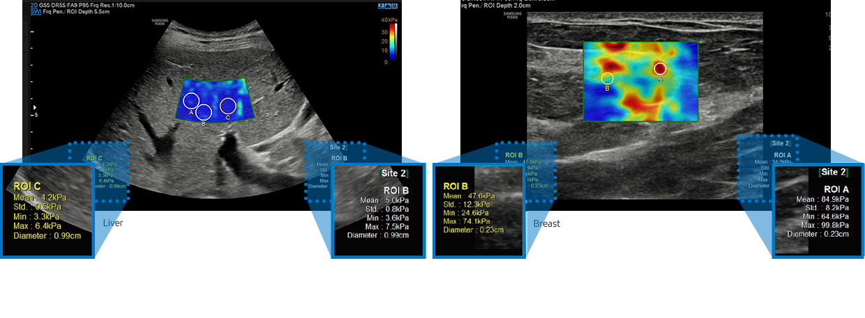fatty liver ultrasound (liver stiffness assessment) : S-Shearwave Imaging™, ultrasound for breast (breast stiffness assessment) : S-Shearwave Imaging™